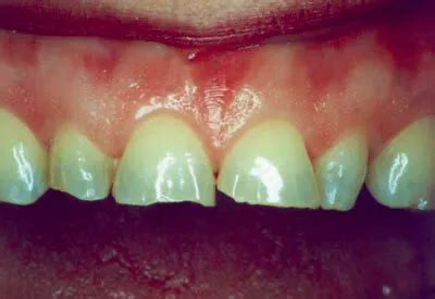 Burnsville Veneers .